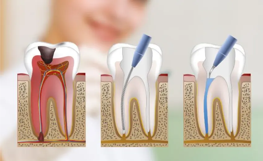 Endodoncia en Carabanchel - Clínica Dental Dr. Jorge González Cogollo