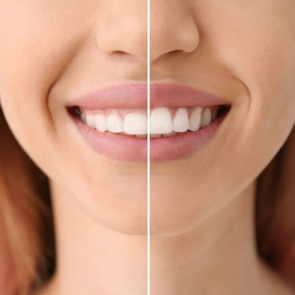 Encías que sangran: cuándo consultar con el dentista